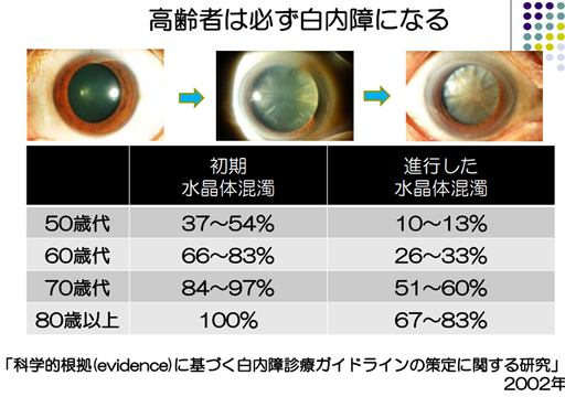 初期白内障の原因は何ですか?