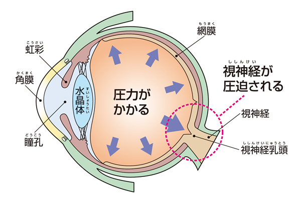 緑内障でもコンタクトを安全に装用するためのヒント